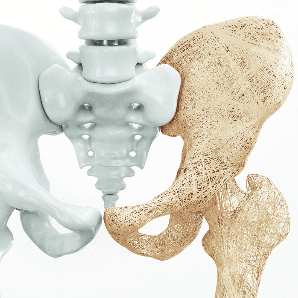 Csontritkulás: a csendes csontbetegség, amelyre oda kell figyelni
