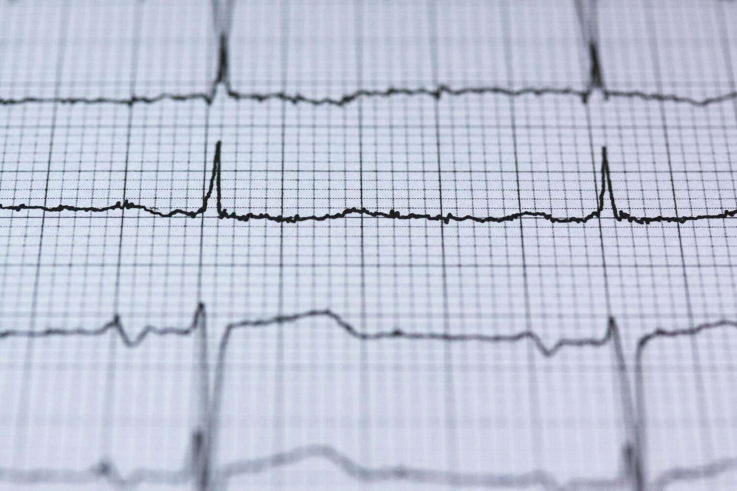 Szívultrahang vs. EKG - Melyik vizsgálat mire való, és hogyan szolgálja szívünk egészségét?